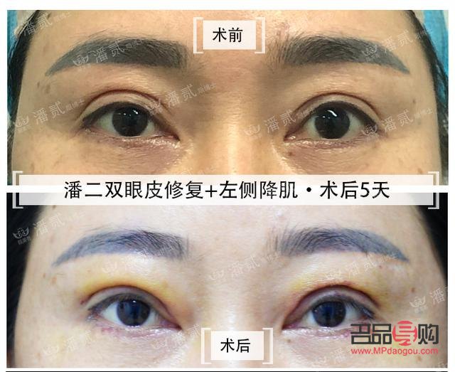 割双眼皮发黄说明快好了吗(割双眼皮发黄说明快好了吗图片) 割双眼皮发黄说明快好了吗(割双眼皮发黄说明快好了吗图片)