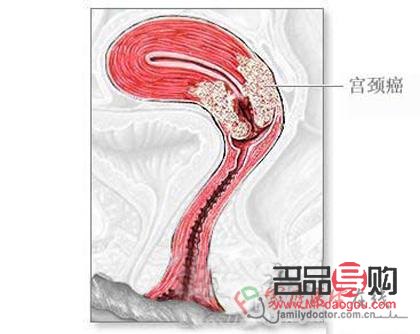 <h3>刮宫后身体护理全攻略</h3>