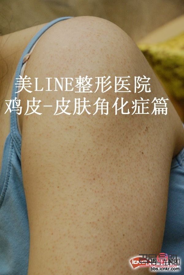 身体护理祛鸡皮效果探讨