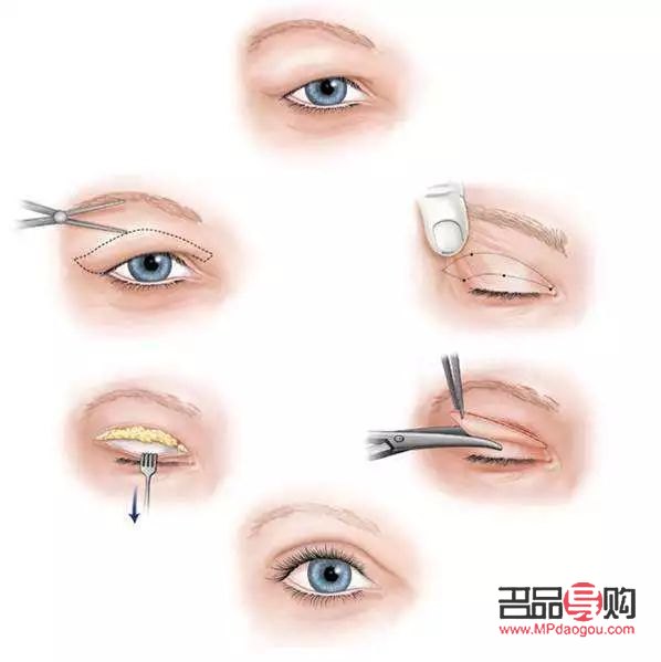 单眼皮与双眼皮的面相之谜