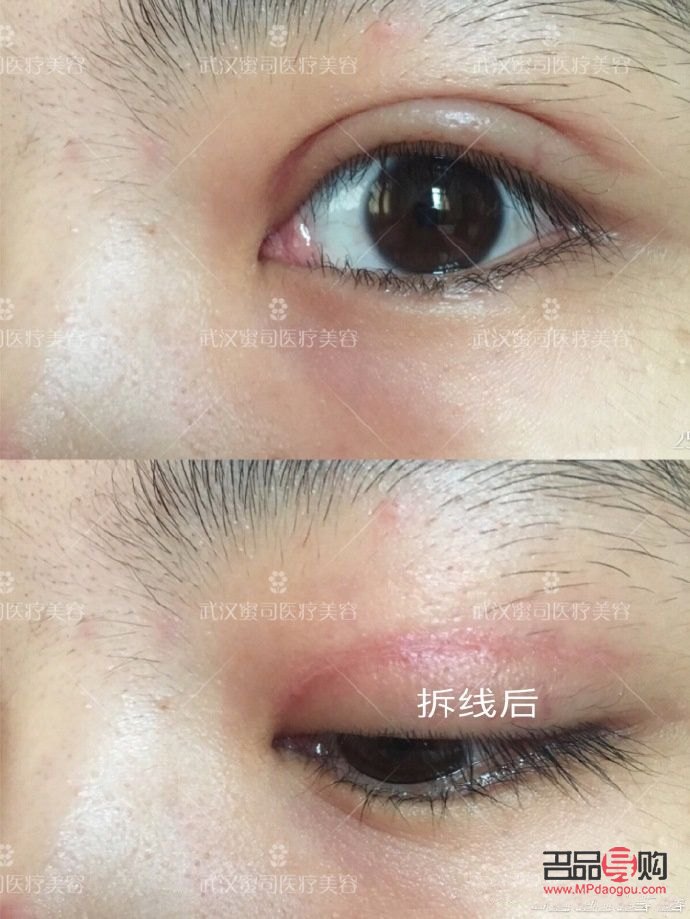 美容线拆线痛吗(美容线拆线痛吗多少钱)