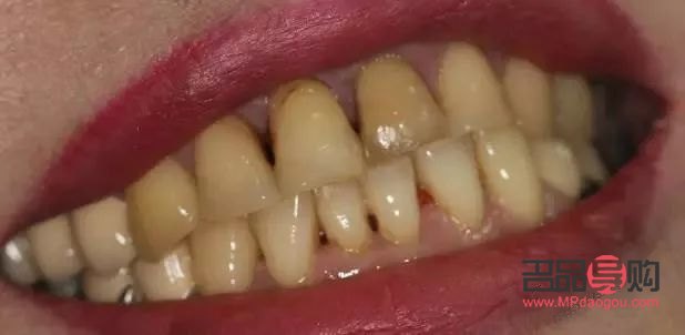 牙尖怎么美容的(牙尖怎么办有什么小妙招)