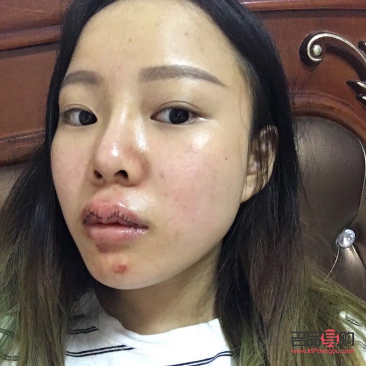 美容可以切嘴唇吗(美容可以切嘴唇吗图片) 美容可以切嘴唇吗(美容可以切嘴唇吗图片)