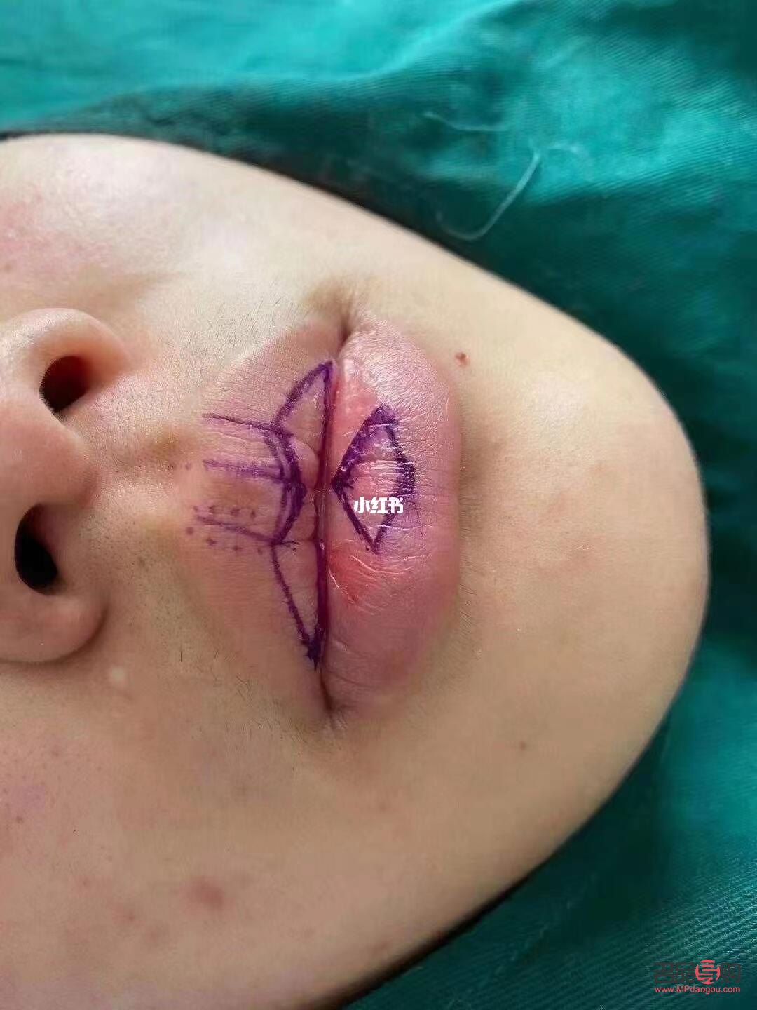 美容可以切嘴唇吗(美容可以切嘴唇吗图片) 美容可以切嘴唇吗(美容可以切嘴唇吗图片)