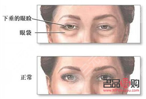 割眼袋有风险吗(割眼袋有风险吗?)