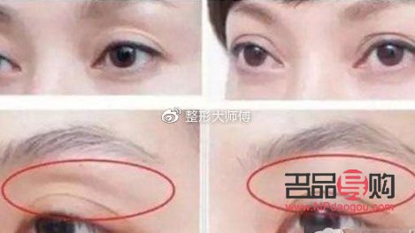 <h3>眼窝凹陷可以填充吗?解析眼部填充手术</h3> <h3>眼窝凹陷可以填充吗?解析眼部填充手术</h3>