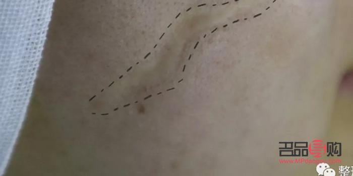 什么是缝美容针(美容缝合针是什么样的)