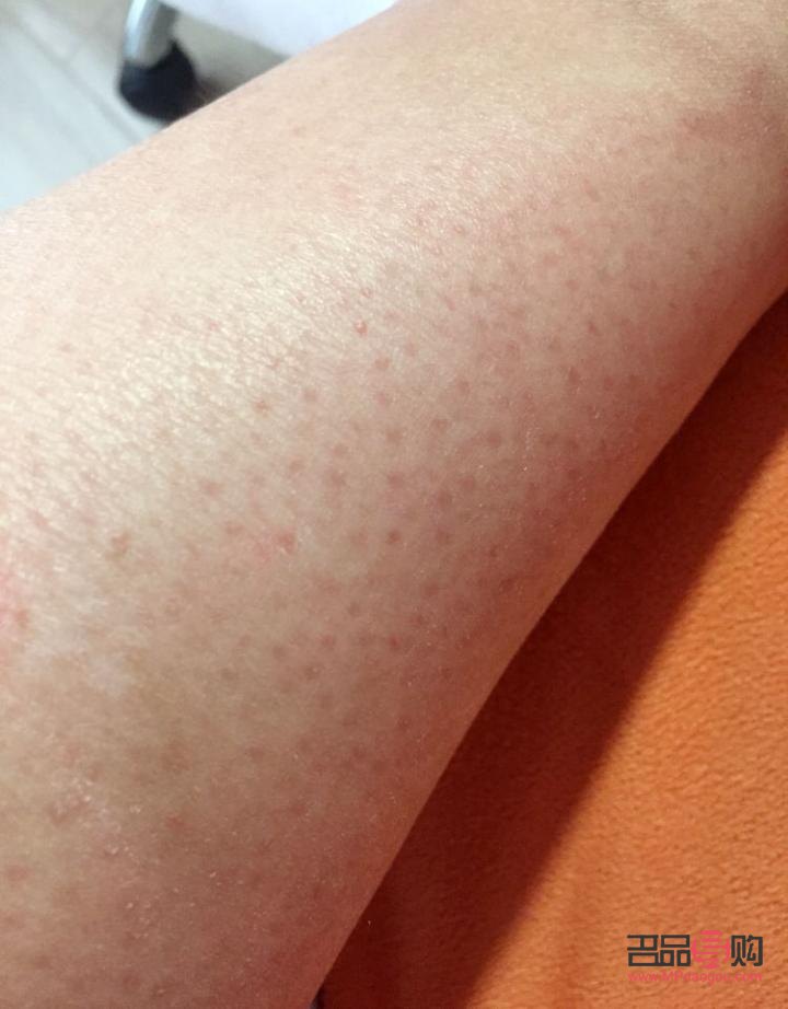 身体鸡皮肤怎么护理(身上的鸡皮肤怎么治)