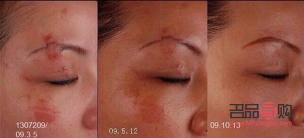 <h3>美容院去疤痕的有效方法</h3> <h3>美容院去疤痕的有效方法</h3>