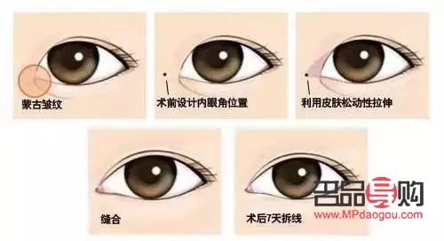 <h3>开外眼角手术前后惊艳对比</h3>