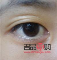 三眼皮(三眼皮怎么恢复双眼皮) 三眼皮(三眼皮怎么恢复双眼皮)