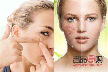 美容院怎么去粉刺(美容院怎么去粉刺的) 美容院怎么去粉刺(美容院怎么去粉刺的)