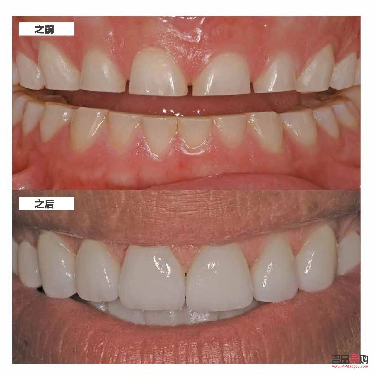 <h3>美容冠:美丽与健康的双重保障</h3> <h3>美容冠:美丽与健康的双重保障</h3>