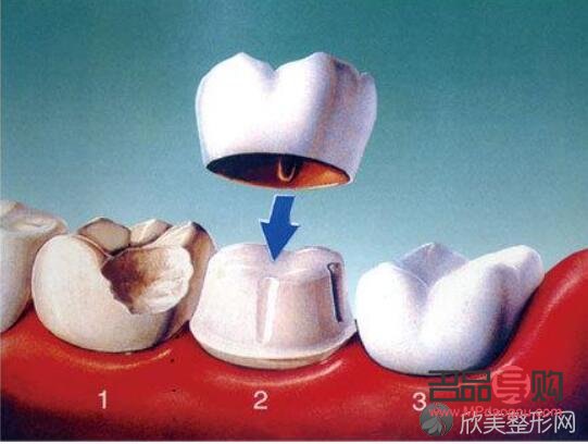 <h3>美容冠:美丽与健康的双重保障</h3> <h3>美容冠:美丽与健康的双重保障</h3>