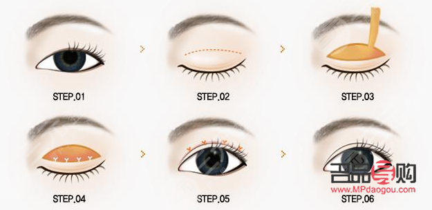 做双眼皮手术多少钱(西南医院做双眼皮手术多少钱) 做双眼皮手术多少钱(西南医院做双眼皮手术多少钱)