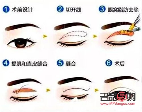 做双眼皮手术多少钱(西南医院做双眼皮手术多少钱) 做双眼皮手术多少钱(西南医院做双眼皮手术多少钱)