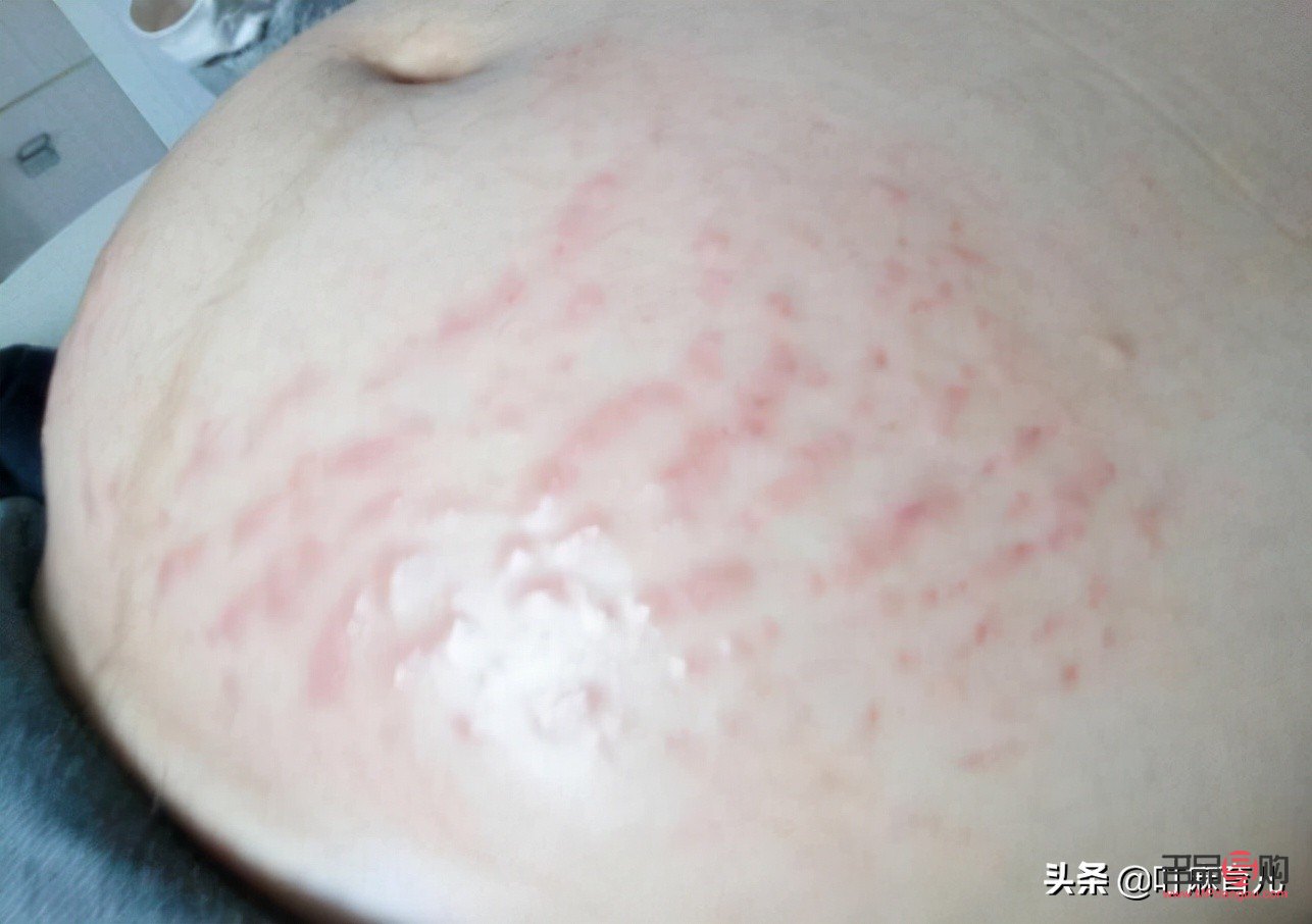 孕妇身体长纹怎么护理(孕妇身上长纹)