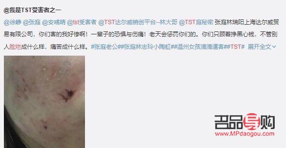 身体烂掉如何有效护理？