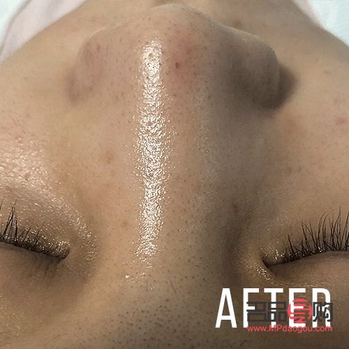 美容去黑头多少钱(美容去黑头多少钱一次鼻子)