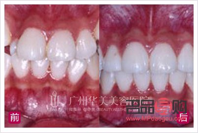 虎牙可以美容冠吗(虎牙可以美容冠吗多少钱)