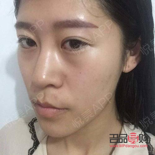 美容埋线怎么回事(美容埋线是怎么回事) 美容埋线怎么回事(美容埋线是怎么回事)
