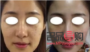 美容埋线怎么回事(美容埋线是怎么回事) 美容埋线怎么回事(美容埋线是怎么回事)