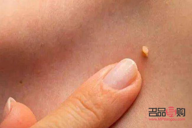 长疣怎么身体护理(长疣怎么身体护理最好)