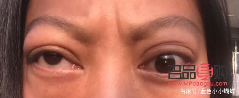 甲亢引起眼睛一大一小怎么办(甲亢引起眼睛一大一小怎么办呢)