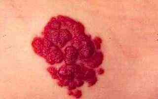 天使之吻胎记(红色胎记手按压就消失)插图4 天使之吻胎记(红色胎记手按压就消失)插图4