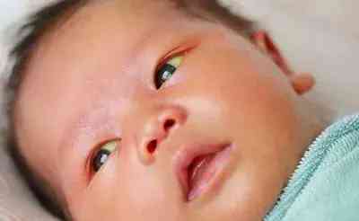 天使之吻胎记(红色胎记手按压就消失)插图11 天使之吻胎记(红色胎记手按压就消失)插图11