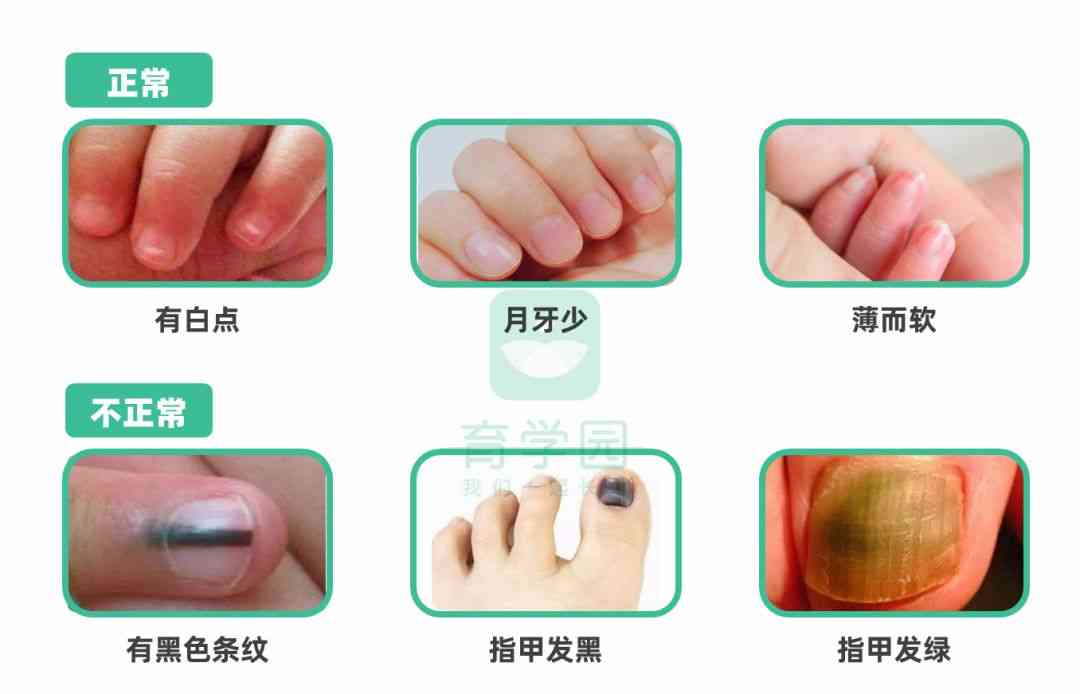 天使之吻胎记(红色胎记手按压就消失)插图14 天使之吻胎记(红色胎记手按压就消失)插图14