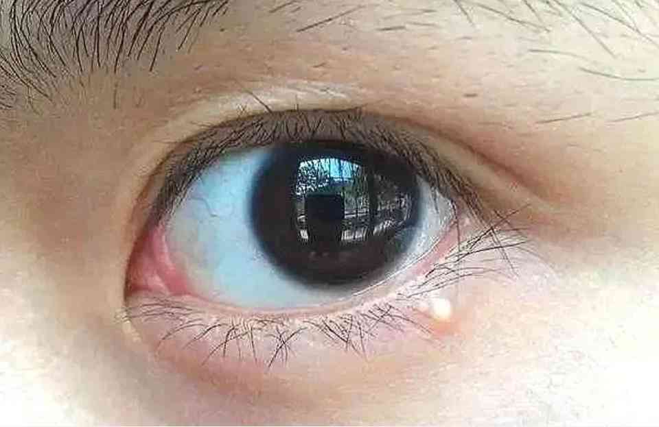 擦化妆品脸长脂肪粒(擦化妆品脸长脂肪粒怎么处理)