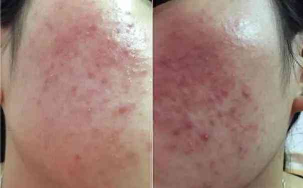 化妆品会造成脸部浮肿吗(化妆品会造成脸部浮肿吗知乎)